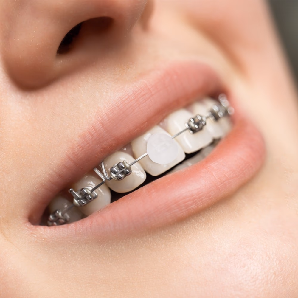 Kin Orthodontic Wax Standard for Braces and Aligners 5