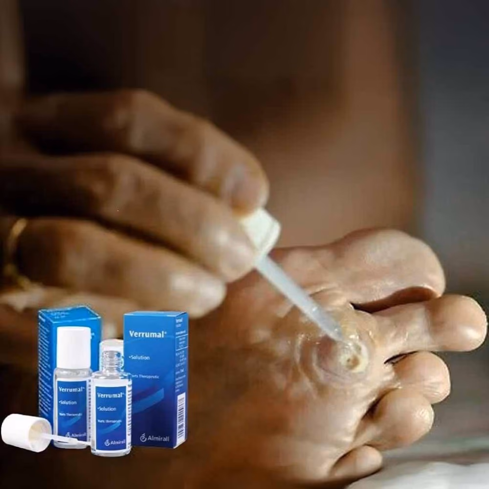 VERRUMAL Topical Solution 13ML 2