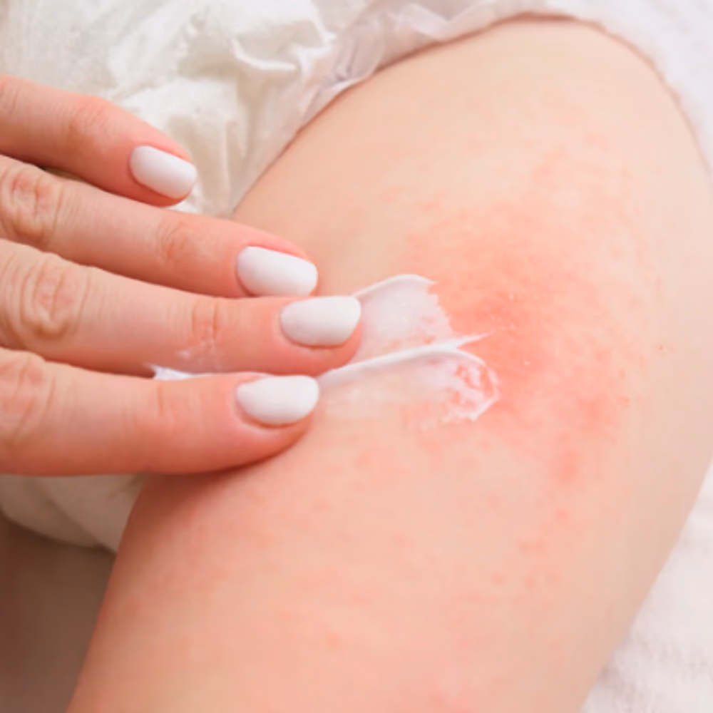 Imavir 5% Skin Cream 15g 3